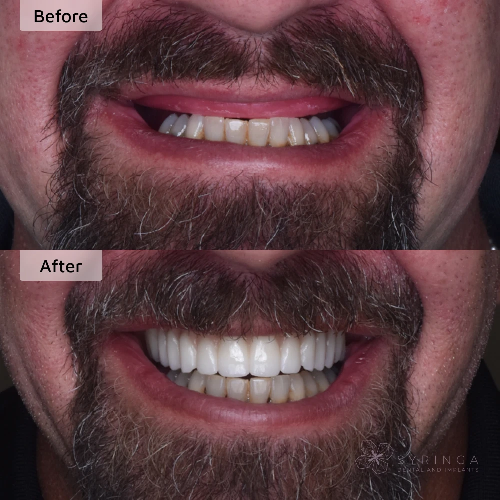 before and after all-on-4 dental implants