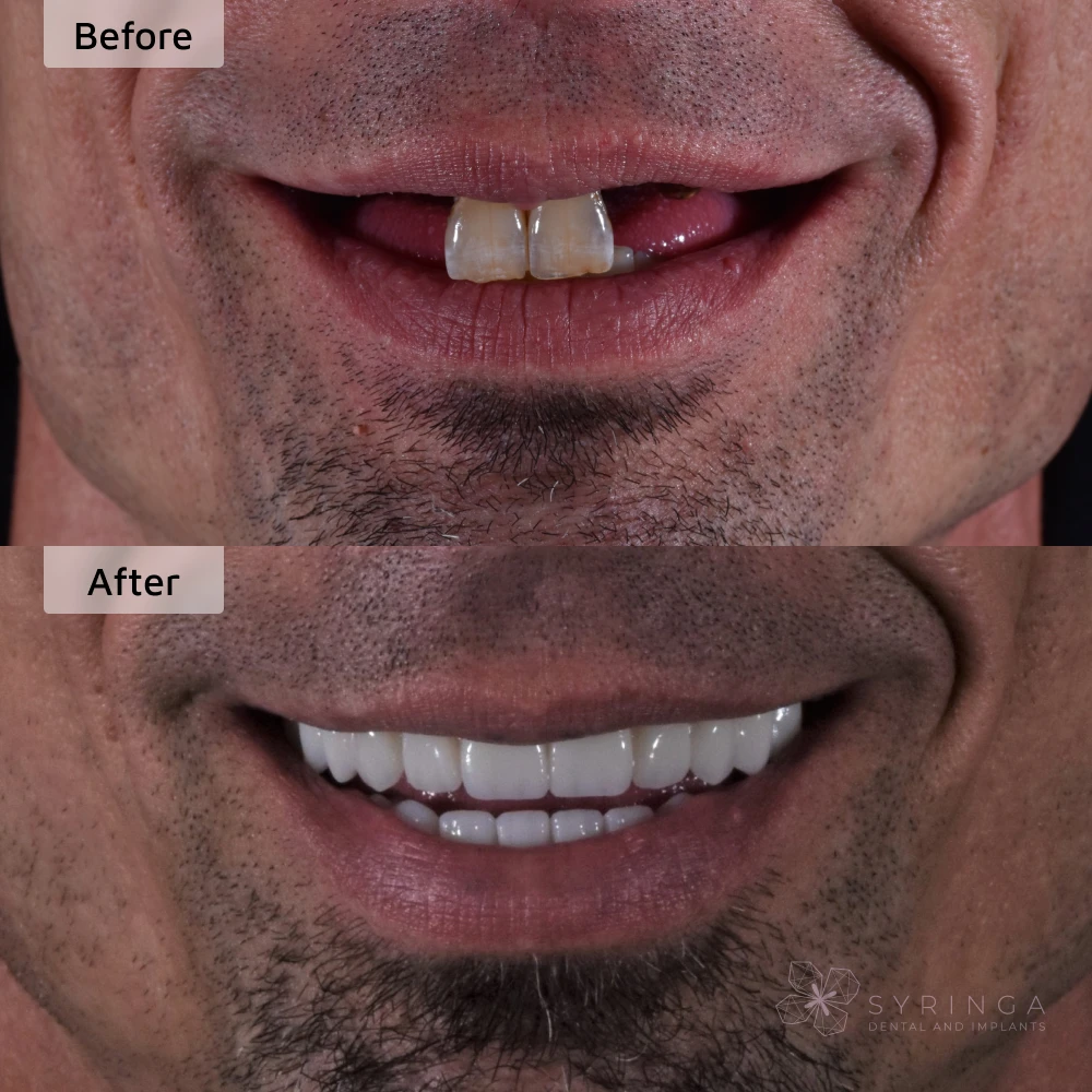 before and after all-on-4 dental implants