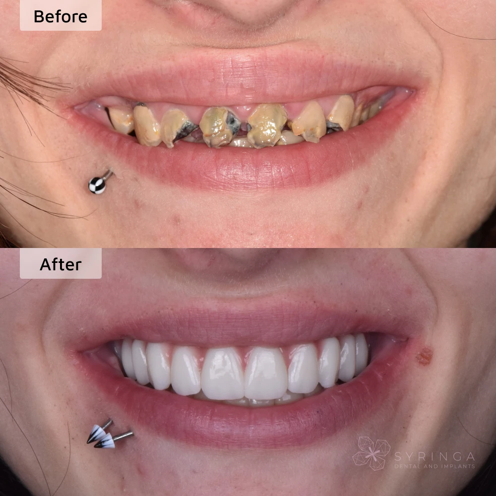 before and after all-on-4 dental implants