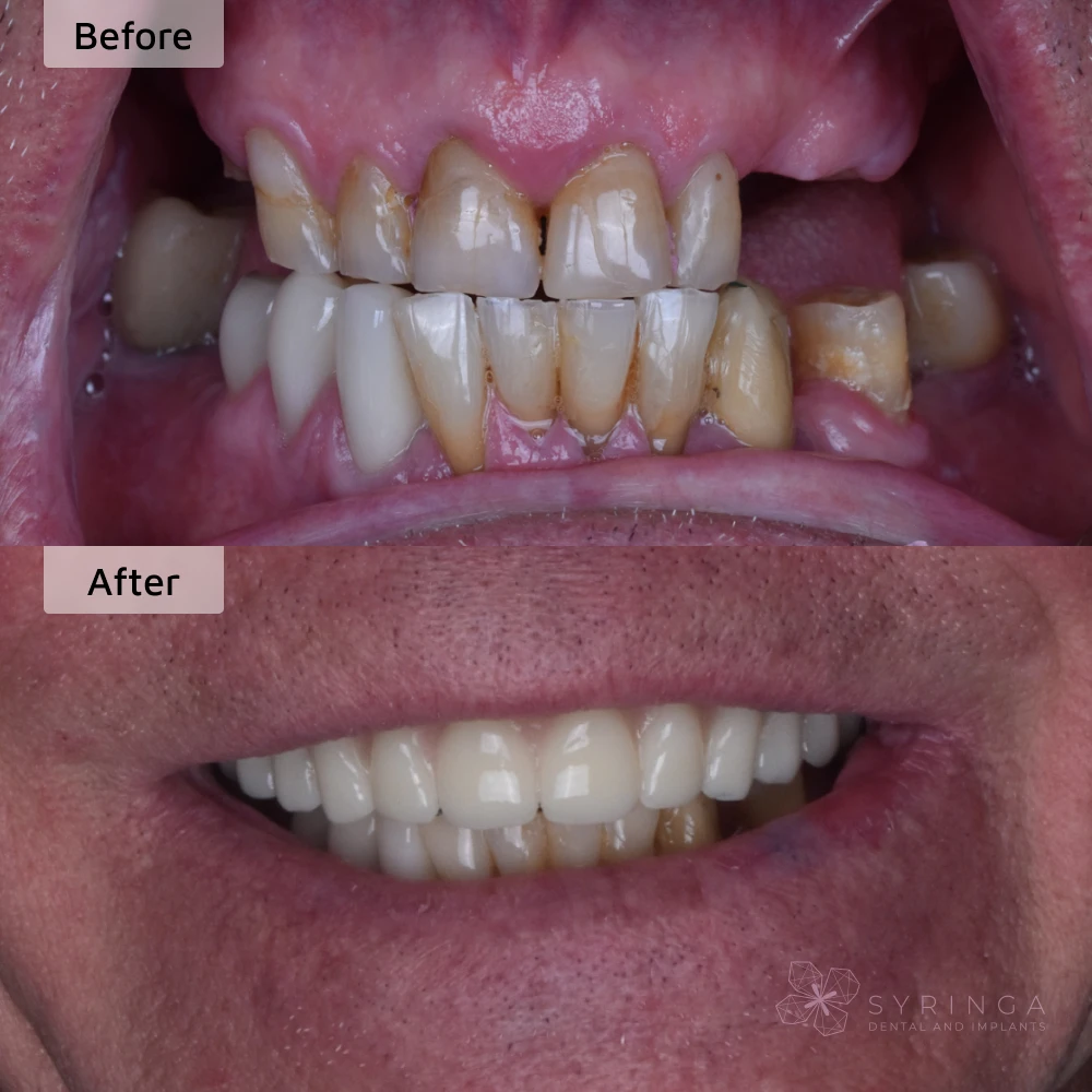 before and after all-on-4 dental implants