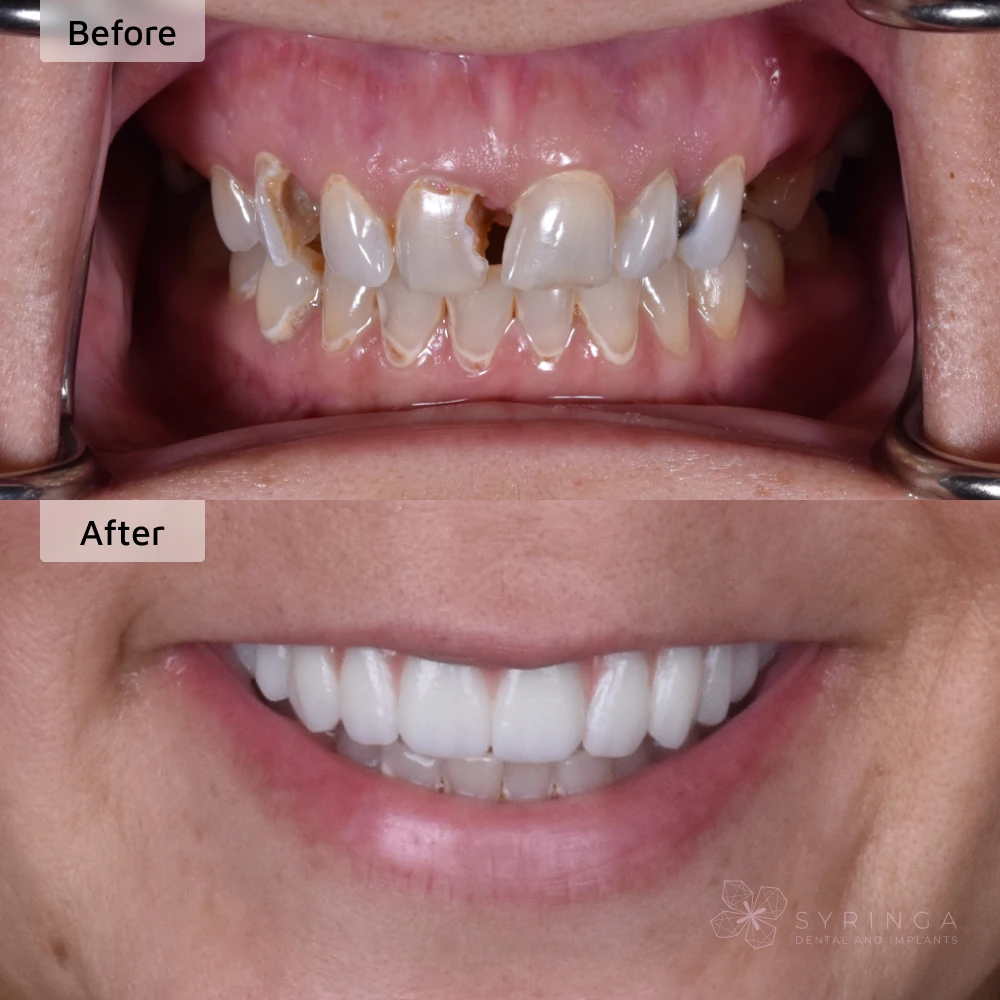 before and after all-on-4 dental implants