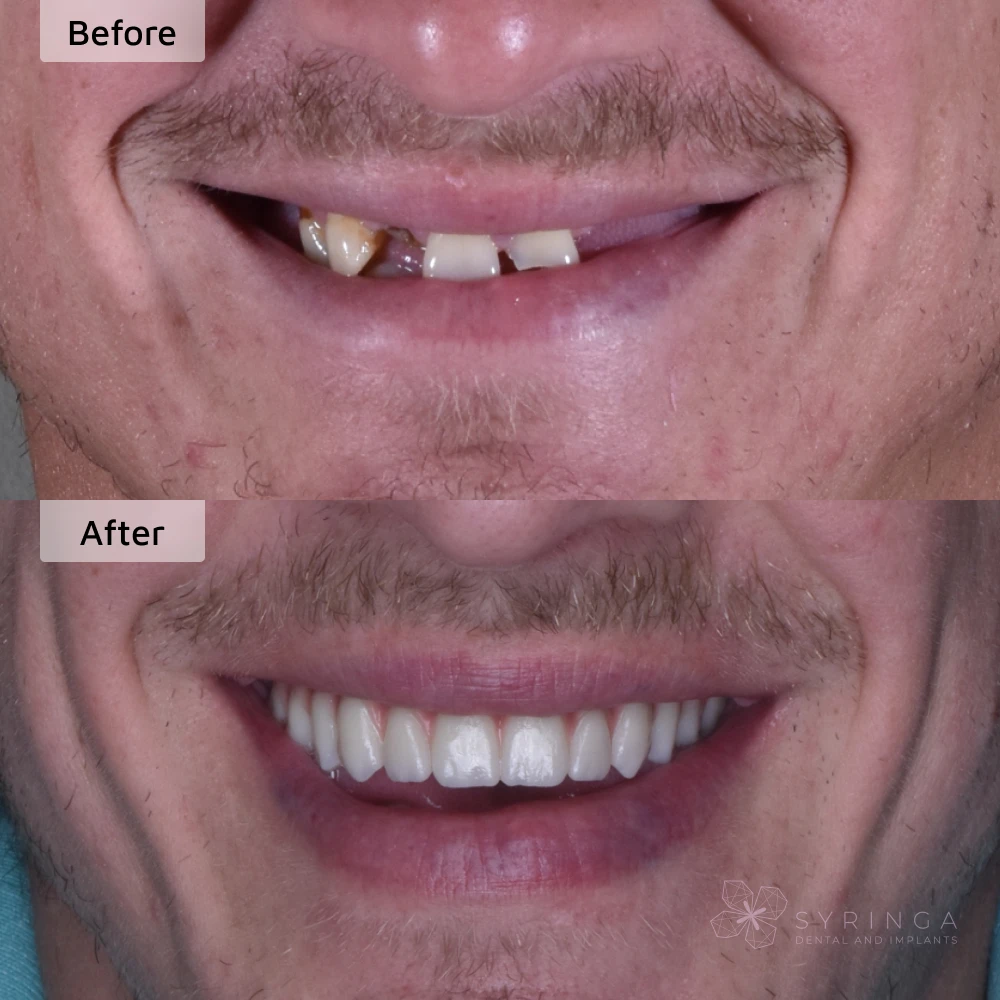 before and after all-on-4 dental implants